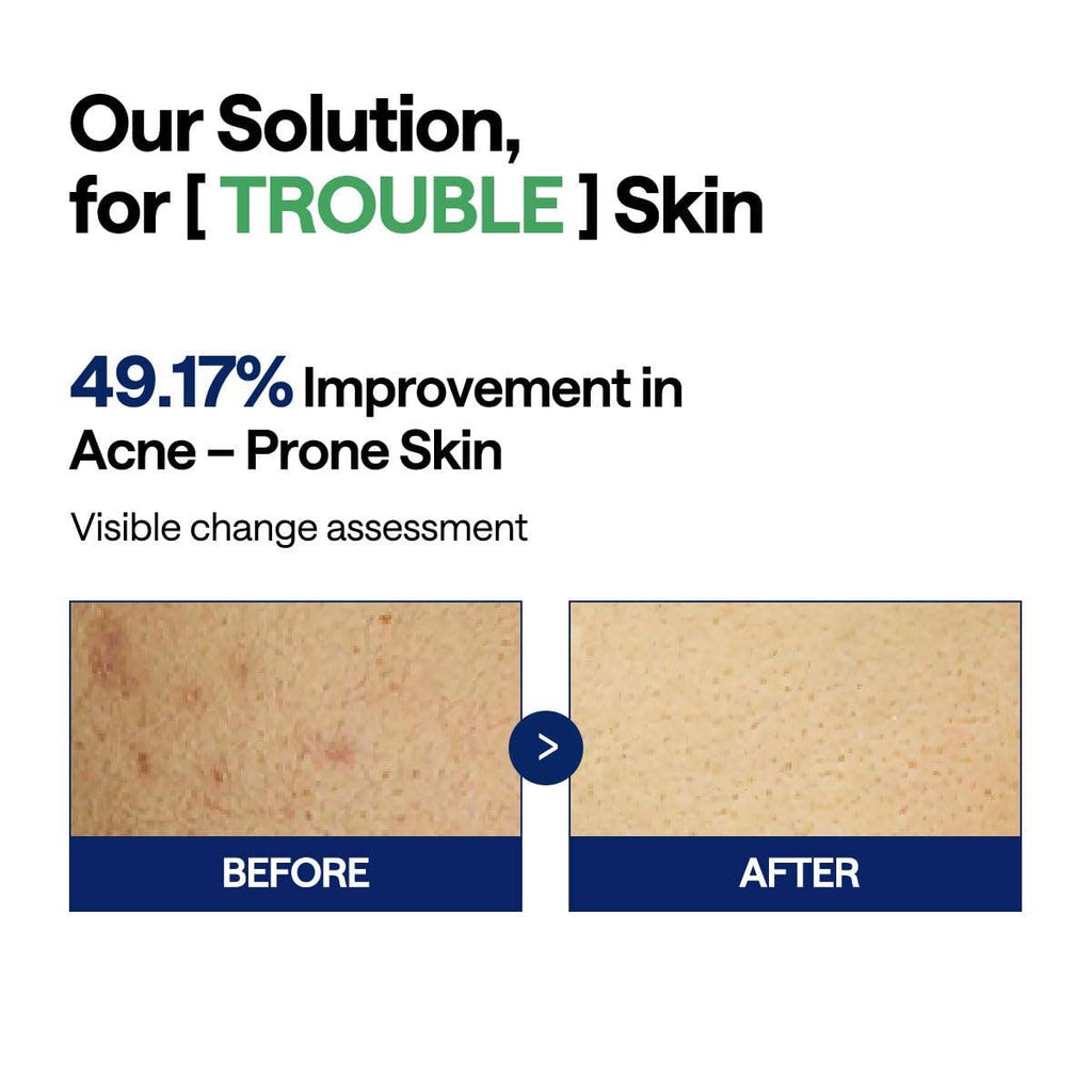 K-Beauty Direct - Mediheal Teatree Trouble Toner Pad – Almohadillas de Gasa Veganas Calmantes y Suavizantes para Piel Propensa al Acné | Venta al por Mayor de K-Beauty